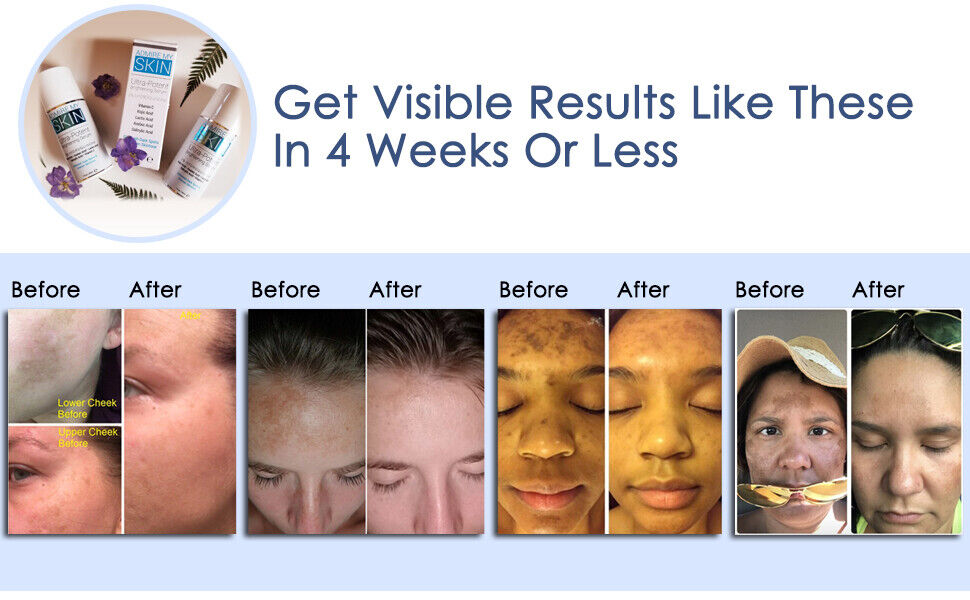 ADMIRE MY SKIN BRIGHTENING SERUM Whitening Lightening Dark Spot Bleaching Cream