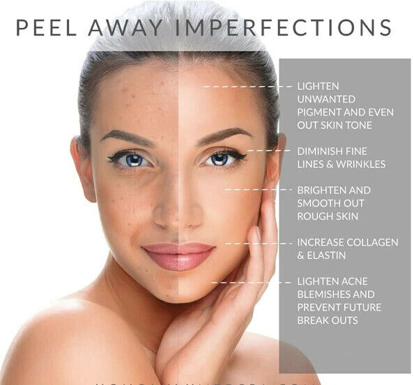 LACTIC ACID FACIAL SKIN PEEL Acne Wrinkles Melasma Age Sun Spots 25% 40% 50% 90%
