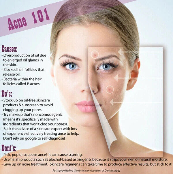 LACTIC ACID FACIAL SKIN PEEL Acne Wrinkles Melasma Age Sun Spots 25% 40% 50% 90%