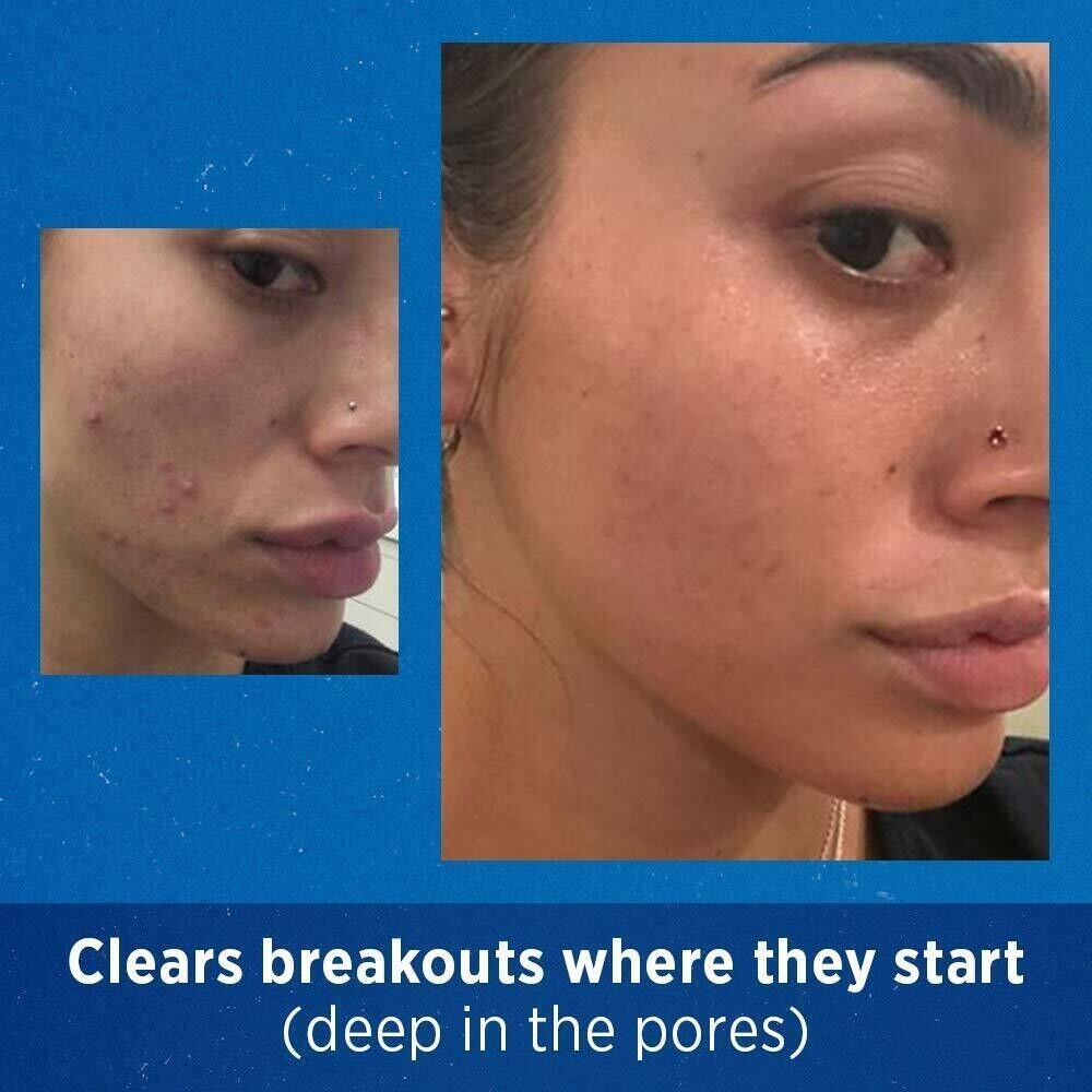 Differin 0.1% Adapalene Gel Maximum Strength Acne Treatment 45g | 90DaySupply