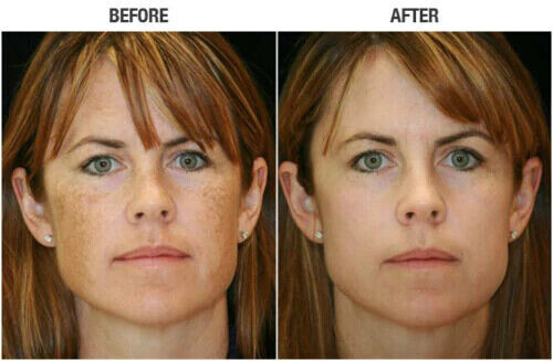 LACTIC ACID FACIAL SKIN PEEL Acne Wrinkles Melasma Age Sun Spots 25% 40% 50% 90%