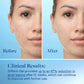 Differin 0.1% Adapalene Gel Maximum Strength Acne Treatment 15g | Pump Bottle