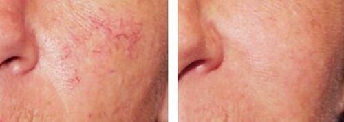 Lux Vitamin K Cream Eliminate Spider Varicose Veins Scars Rosacea Capillaries