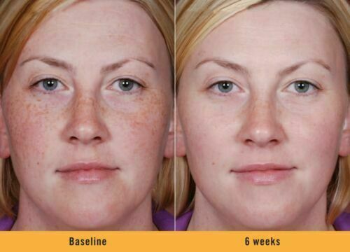 DARK SKIN WHITENING LIGHTENING ULTRA BRIGHTENING SERUM 30mL - FREE EXPRESS POST