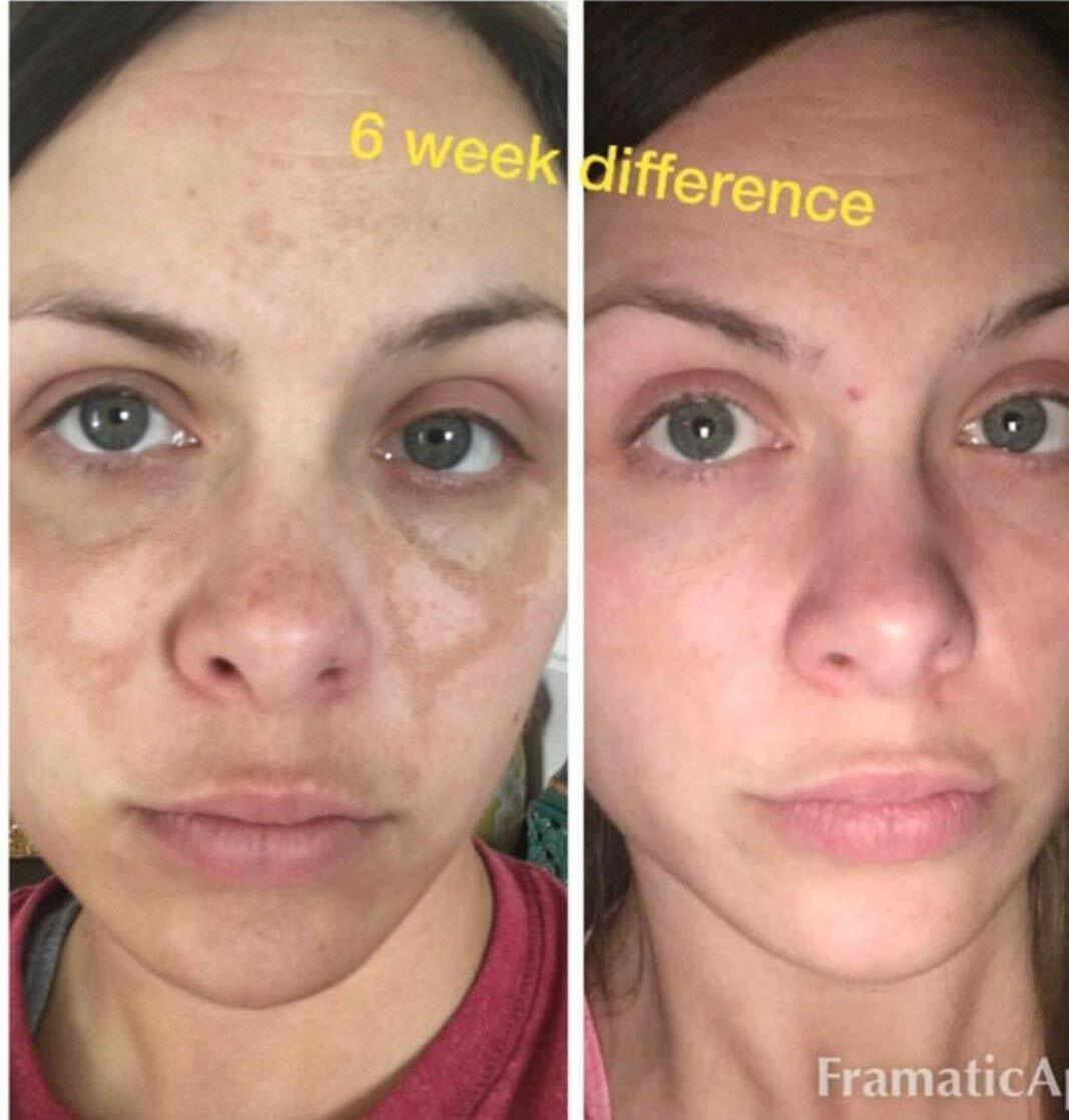 ADMIRE MY SKIN BRIGHTENING SERUM Whitening Lightening Dark Spot Bleaching Cream