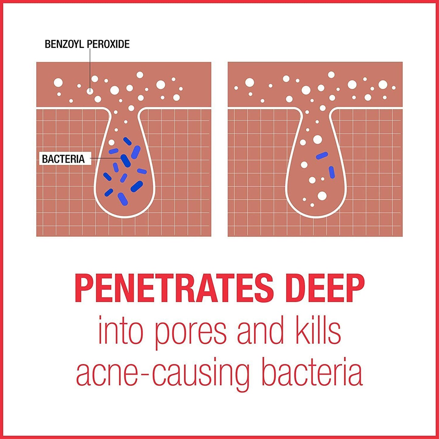 Neutrogena Stubborn Acne AM Treatment DAY Skin Care 2.5% Benzoyl Peroxide 56g