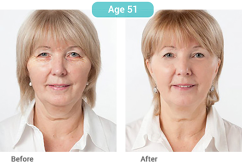 STEM CELL SERUM Anti Aging Real Stem Cell Cultures Matrixyl 3000 Hyaluronic Acid