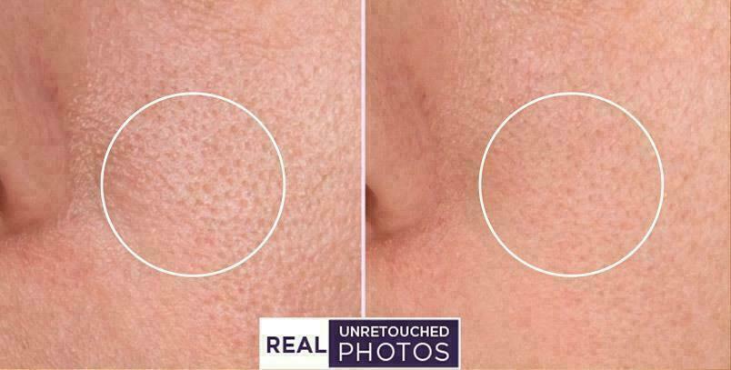 RETINOL VITAMIN A 5% + HYALURONIC ACID + Vitamin E Serum 30ml FREE EXPRESS POST!