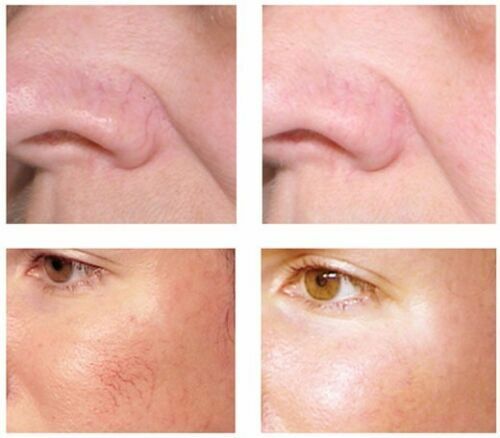 Lux Vitamin K Cream Eliminate Spider Varicose Veins Scars Rosacea Capillaries