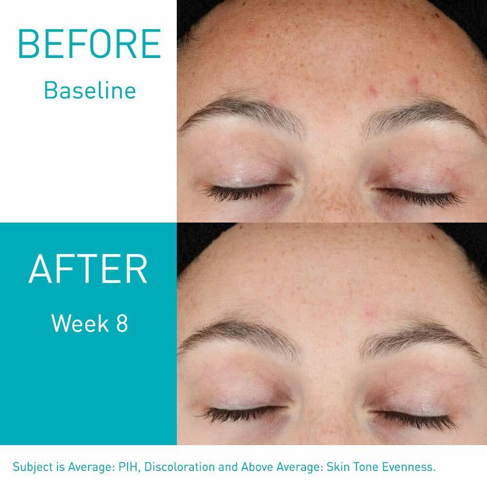 CeraVe - Resurfacing Retinol Face Serum - Post-Acne Marks Skin Care - 30 mL NEW