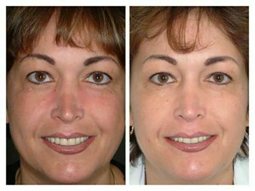 MicroDermabrasion Cream Crystals Scrub Anti Aging Wrinkle Resurfacing Exfoliant