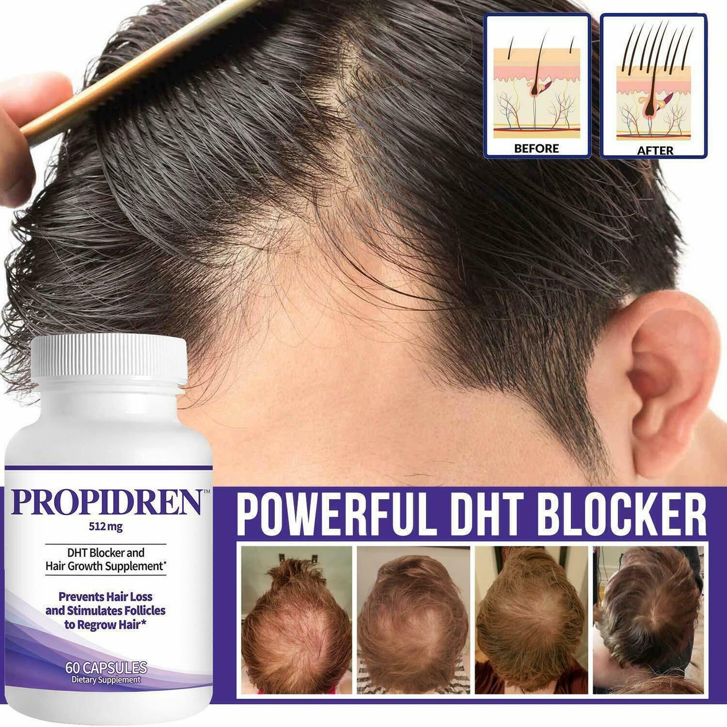 PROPIDREN Hair Growth Loss Vitamins DHT Blocker Biotin Saw Palmetto Supplement