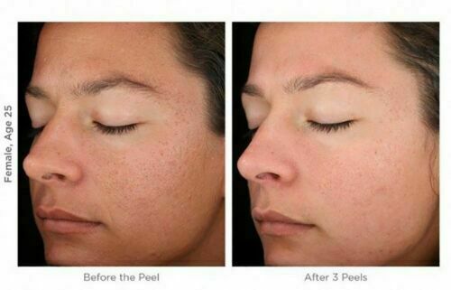 MicroDermabrasion Cream Crystals Scrub Anti Aging Wrinkle Resurfacing Exfoliant