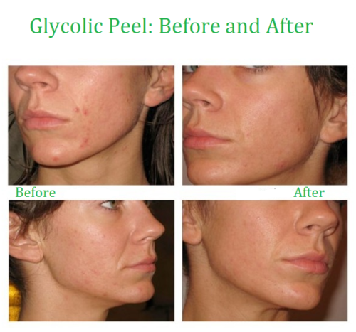 GLYCOLIC ACID CHEMICAL FACE PEEL Kit Medical Grade 100% Pure Acne Scars Wrinkles