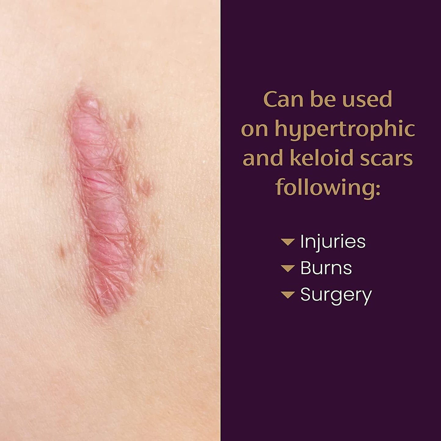 Mederma Medical Grade Silicone Scar Sheet Skin Care Old New Scars - 4 Pack SMALL