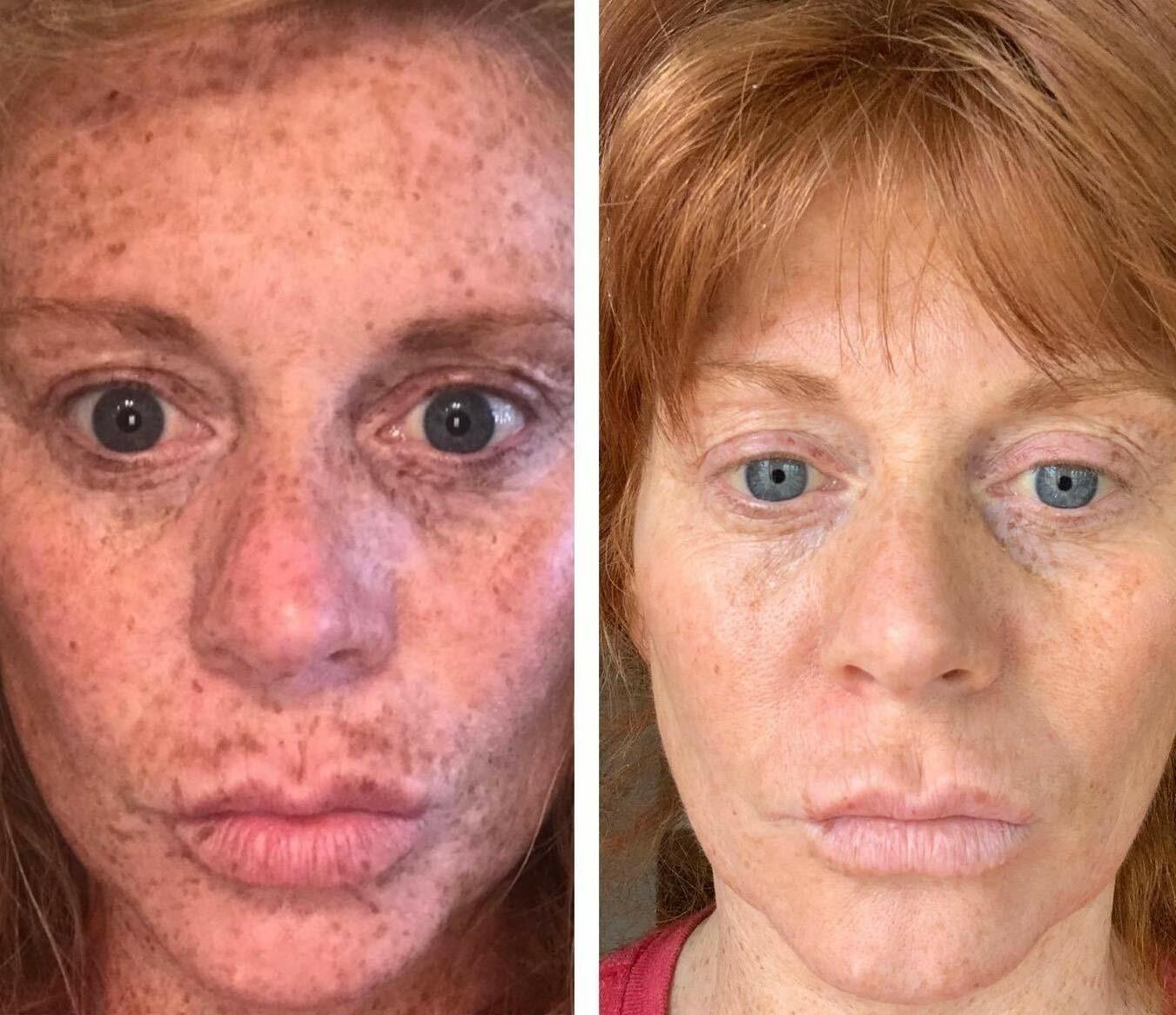 ADMIRE MY SKIN BRIGHTENING SERUM Whitening Lightening Dark Spot Bleaching Cream