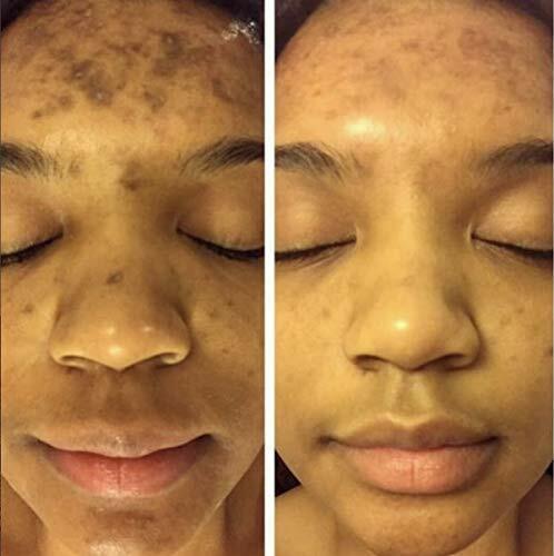 ADMIRE MY SKIN BRIGHTENING SERUM Whitening Lightening Dark Spot Bleaching Cream