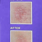 Mederma PM Intensive Overnight Scar Gel Cream Old or New Scars Injury Burns Acne