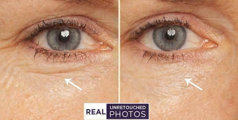 RETINOL VITAMIN A 5% + HYALURONIC ACID + Vitamin E Serum 30ml FREE EXPRESS POST!